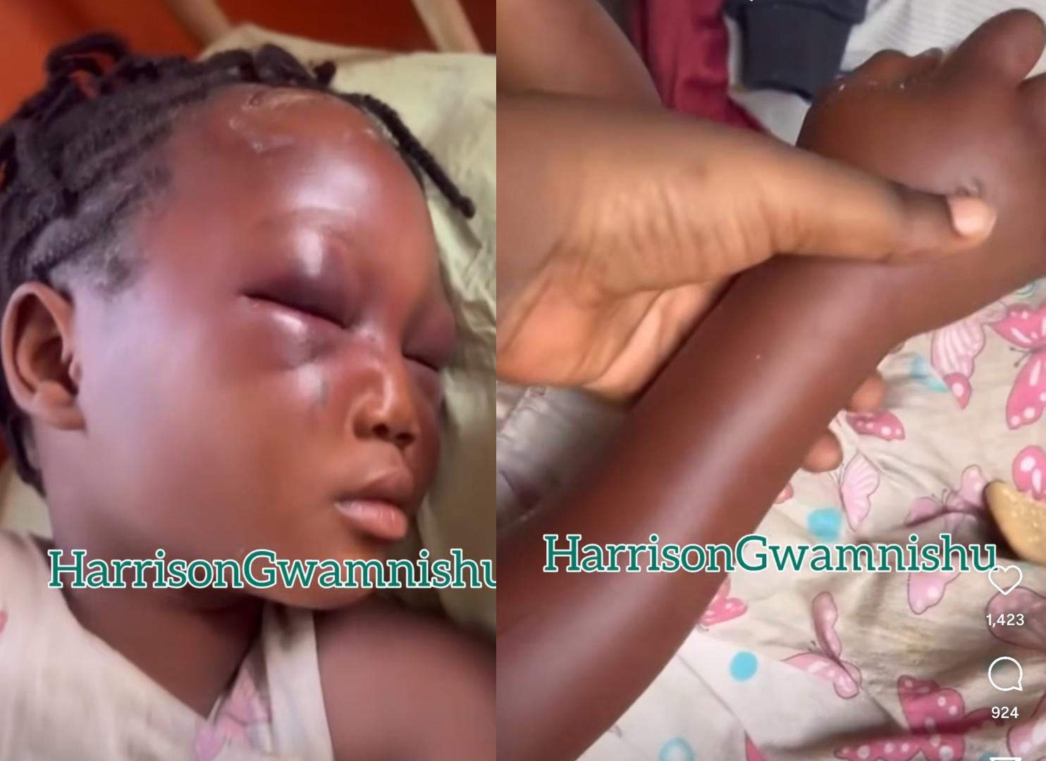 Eight year old left with swollen eyes and hands after she was assaulted by her aunt