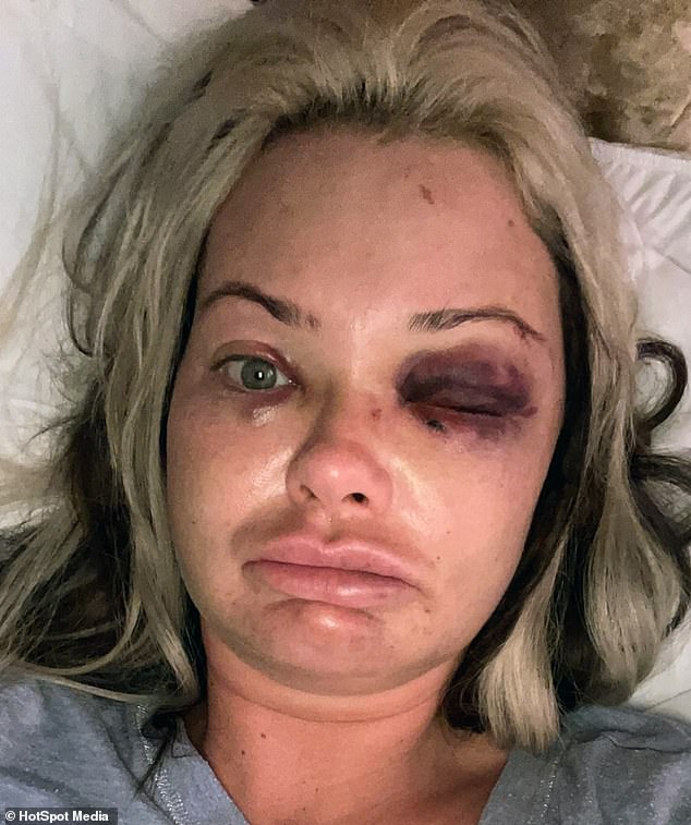 Mother-of-three shares images of her horrific facial injuries after she was attacked by�her�boyfriend