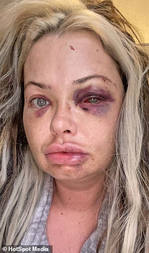 Mother-of-three shares images of her horrific facial injuries after she was attacked by�her�boyfriend